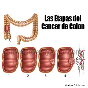 etapas-del-cancer-de-colon